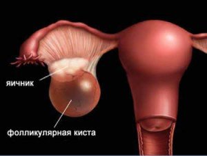 Лікування кісти яєчника народними засобами