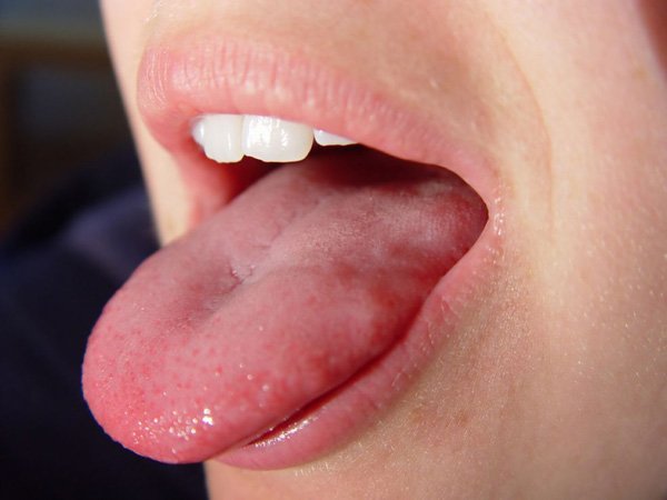 Про що сигналізує коричневий наліт на язиці?