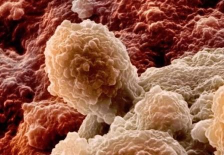 Що потрібно знати про ознаки раку простати у чоловіків