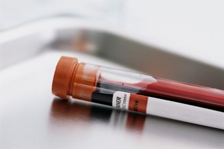 Підвищений білірубін у крові: причини, симптоми і способи зниження