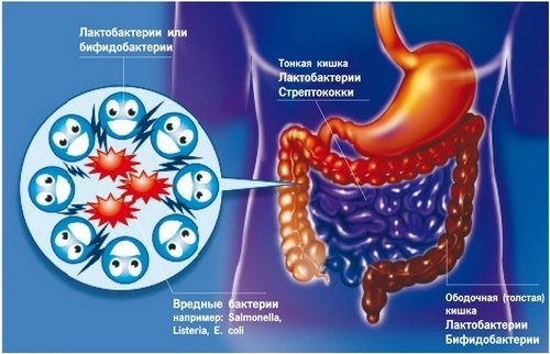 Дисбактеріоз кишечника і його симптоми