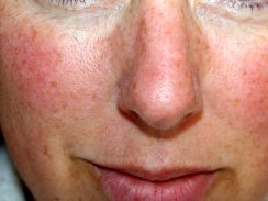 Підшкірний кліщ на обличчі: причини, симптоми, лікування