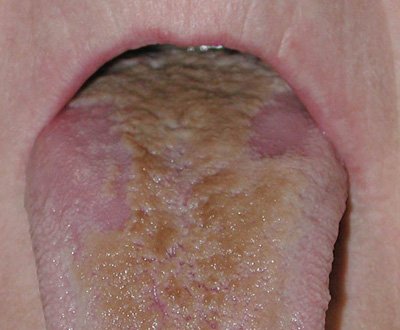Про що сигналізує коричневий наліт на язиці?