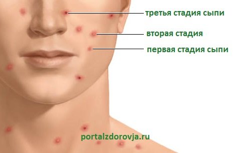 Як розпізнати вітрянку, як вона передається?