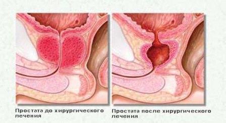 Як проводять операцію з видалення аденоми простати (передміхурової залози)