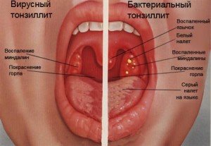 Як використовувати хлоргексидин для полоскання горла при ангіні