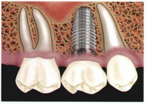 Імплантація зубів. Правда і міфи
