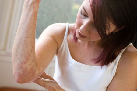 Атопічний дерматит у дорослих: лікування, симптоми та причини хвороби