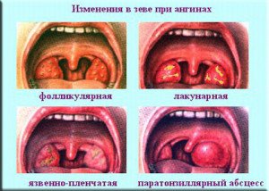 Методи лікування ангіни у дітей