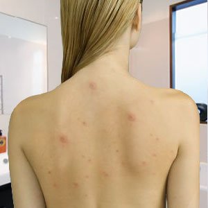 Причини і лікування прищів на спині і плечах