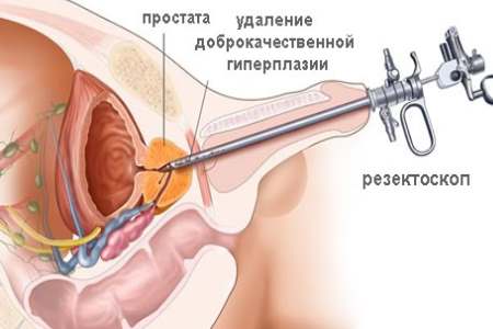 Операційні та інші методи лікування аденоми простати