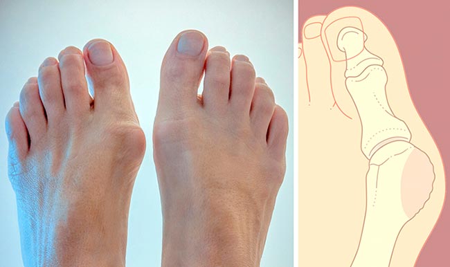 Як лікувати шишку на великому пальці ноги: 2 дієвих способу