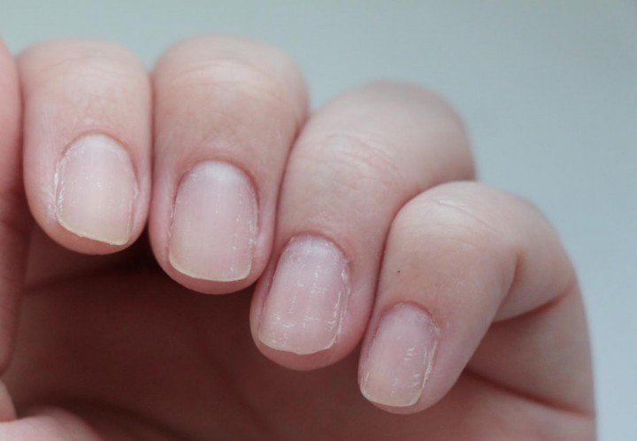 Чому шаруються нігті на руках? Що робити? Причини і лікування листковий і ламкості нігтів