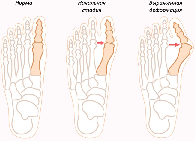 Як лікувати шишку на великому пальці ноги: 2 дієвих способу