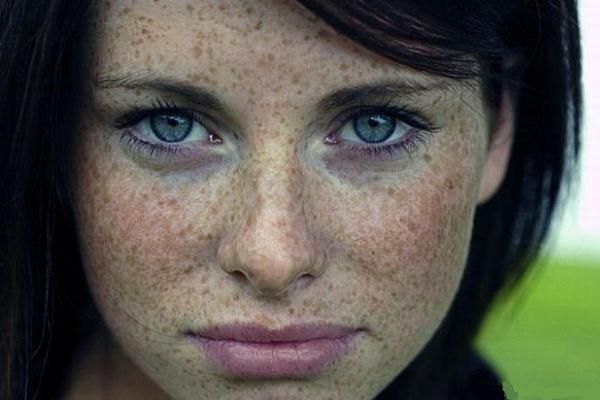 Пігментні плями на обличчі: види і причини появи