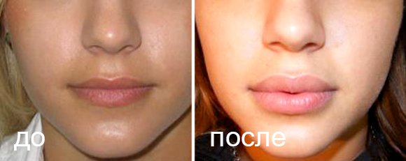 Способи збільшення губ: ДО і ПІСЛЯ фото + відео процедури