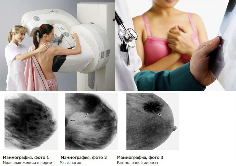 Що таке мамографія?