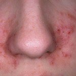 Себорейний дерматит на обличчі