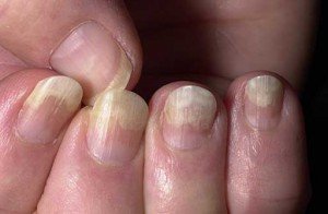 Лікування народними засобами грибкові ураження нігтів