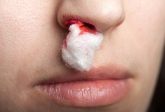 Кровотеча з носа: причини і що робити?