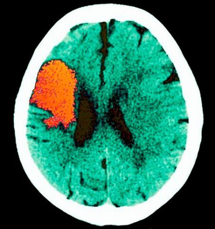 ЕЕГ головного мозку у дітей