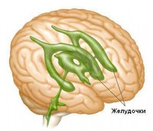 Гідроцефалія головного мозку у дорослих