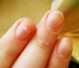Що означають плями на нігтях у дорослих і дитини?