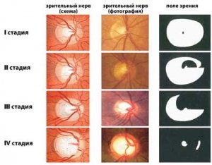 Симптоми, ознаки і лікування атрофії зорового нерва