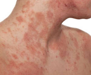 Види алергічного дерматиту — як лікувати в домашніх умовах