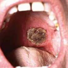 Клінічна картина гранулематоза Вегенера, форми захворювання