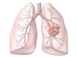 Діагностика та лікування раку легенів