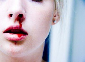 Кровотеча з носа: в чому причина і що робити?