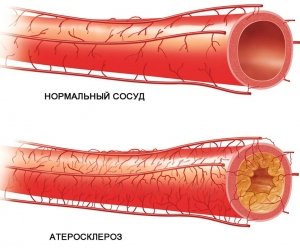Атеросклероз нижніх кінцівок: як не пропустити хвороба!