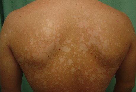 Плями на шкірі в місцях сильного потовиділення: потрібен прийом препаратів усередину або досить зовнішніх засобів