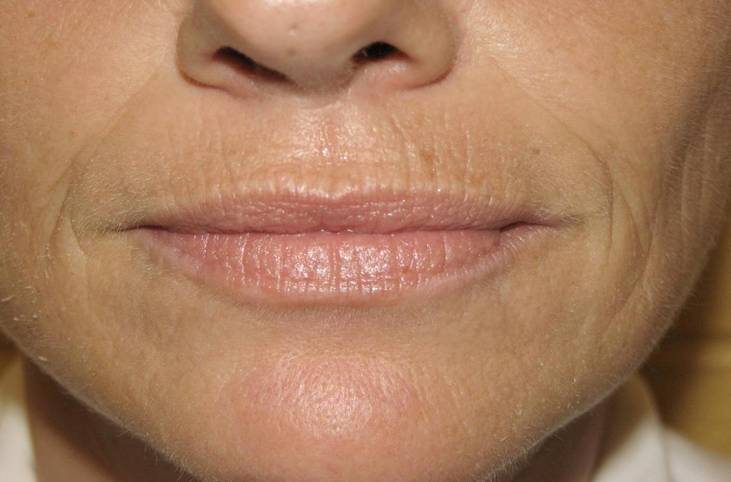 Прості та ефективні методи позбавлення від зморшок в області губ