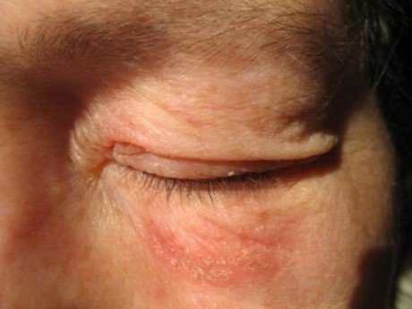 «Опік шкіри навколо очей після застосування китайського крему від зморшок