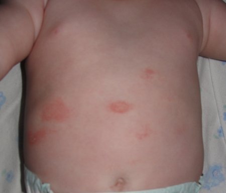 Червоні шершаві плями на тілі у дитини: що робити?