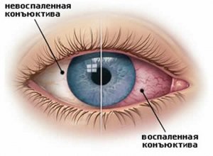 Народні поради та рекомендації, як швидко впоратися із запаленням очей