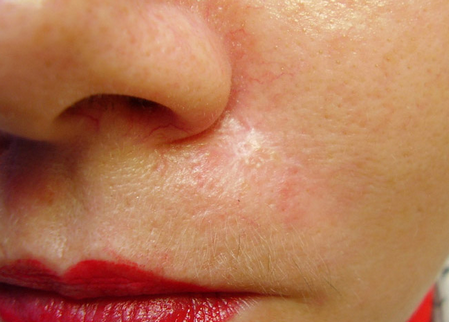 Вибираємо спосіб боротьби з рубцями на обличчі в залежності від виду пошкодження шкіри