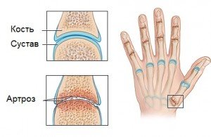 Артроз суглобів пальців рук