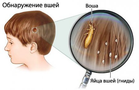 Воші у дитини