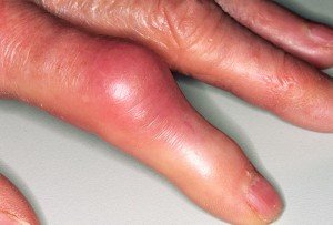 Артрит суглобів пальців рук