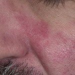 Себорейний дерматит на обличчі