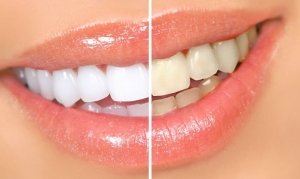 11 способів домашнього відбілювання зубів народними засобами