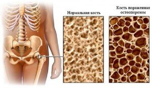 Профілактика і лікування остеопорозу