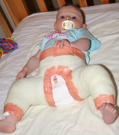 Дисплазія кульшових суглобів у новонароджених