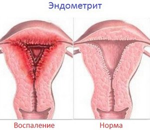 Чим небезпечний для жінки ендометрит?