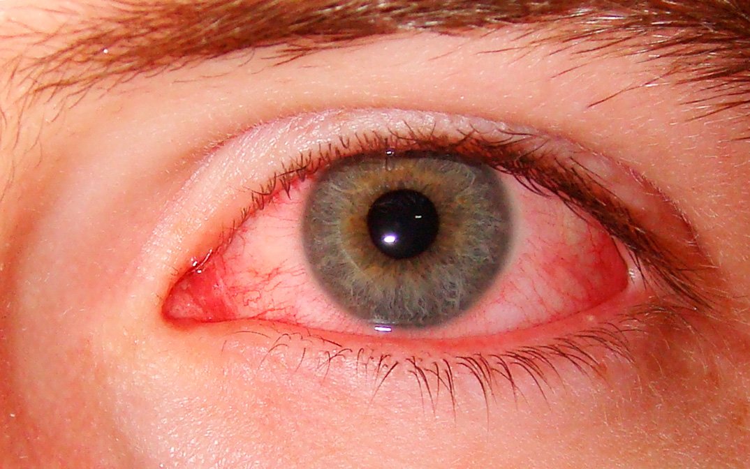 Чому червоні білки очей? Частина 1