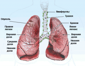 Незвичайні симптоми, стадії та лікування раку легенів