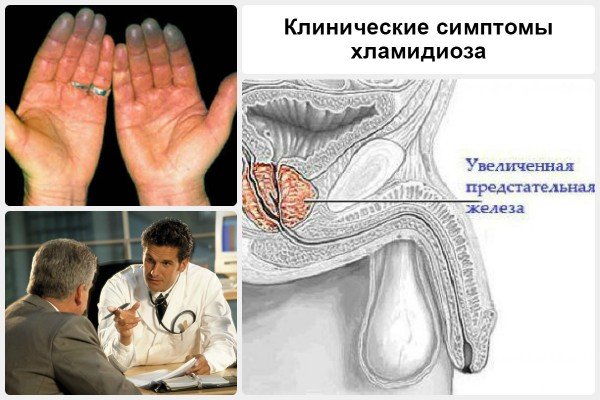Симптоми, діагностика та профілактика хламідіозу у чоловіків